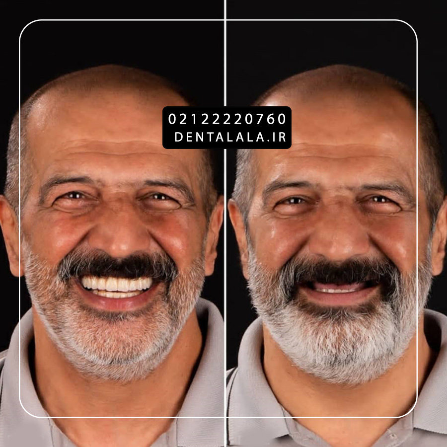 اوردنچر فک بالا